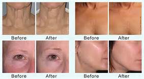 Машина Кореи Microneedle частичная RF для рафинировки поры, удаления шрама угорь